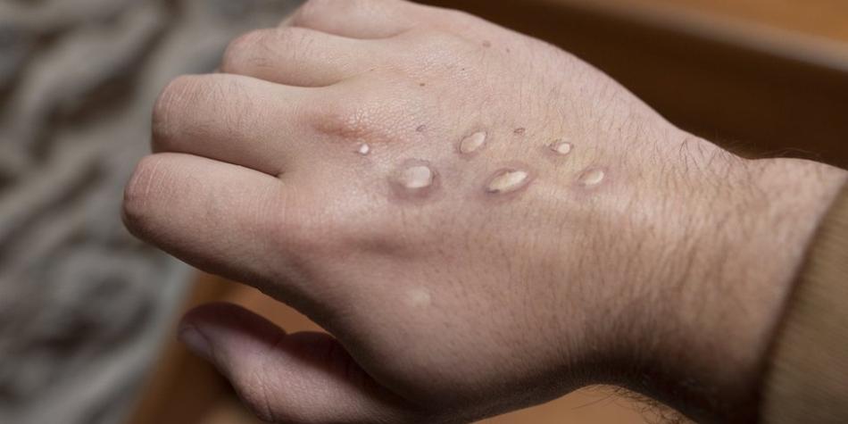 BBC Mundo: Monkeypox Skin hashes on the hand of a man